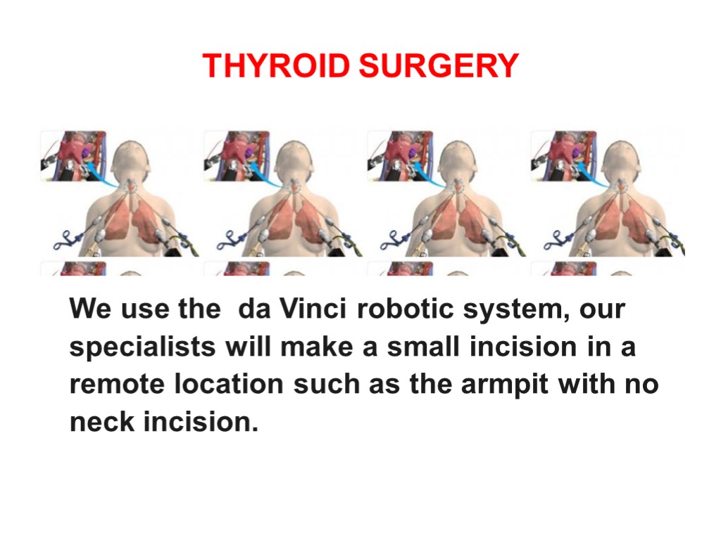 THYROID SURGERY We use the da Vinci robotic system, our specialists will make a